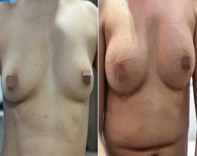 Best Breast Lift surgery in islmabad