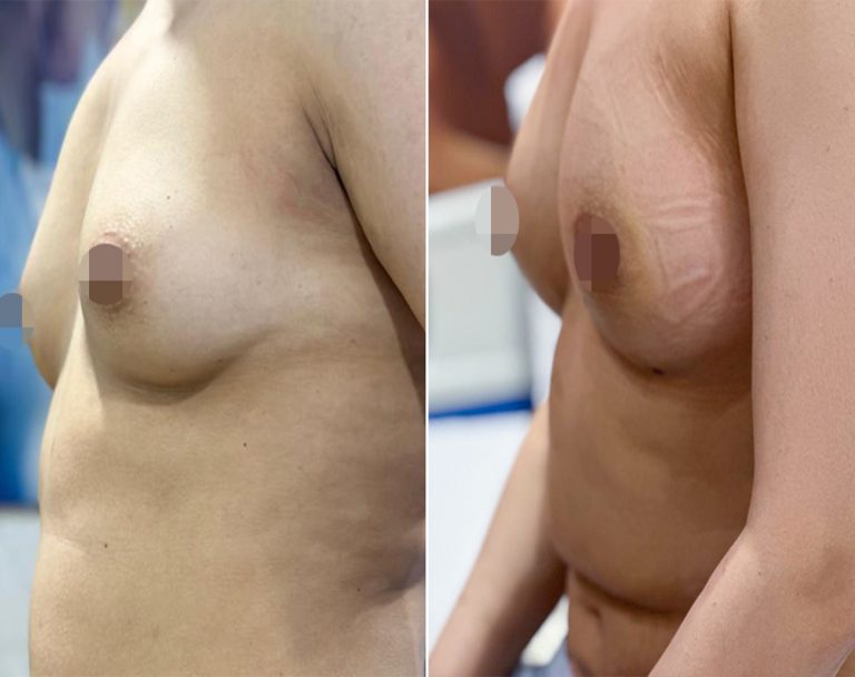 Best Breast Lift surgery in islmabad