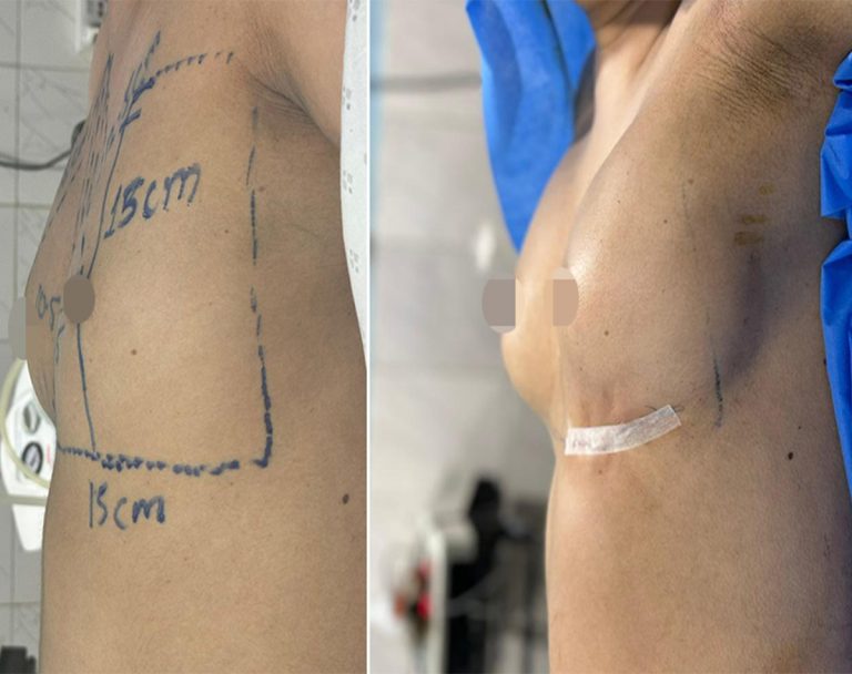 Best Breast Lift surgery in islmabad