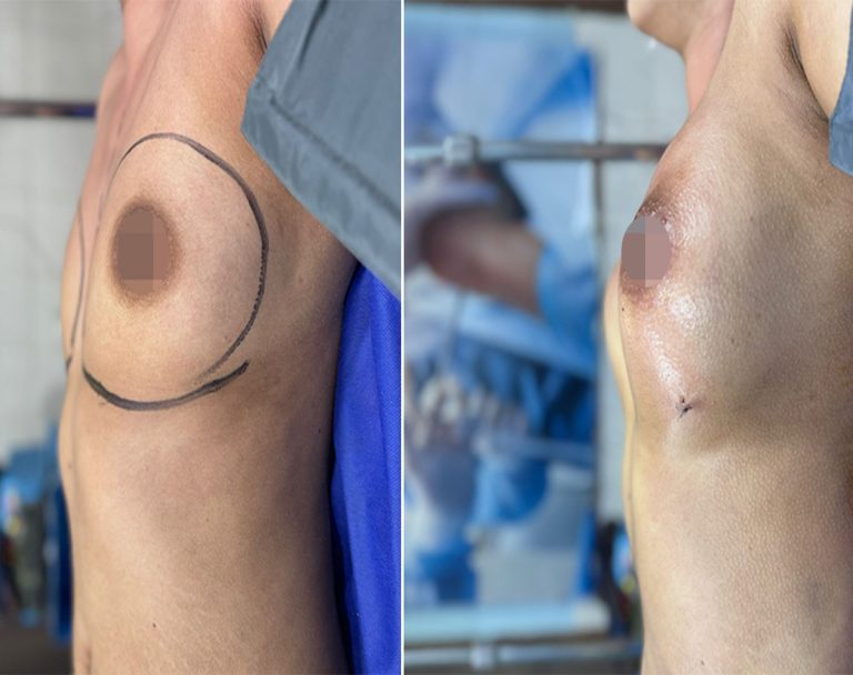 Best Breast Lift surgery in islmabad