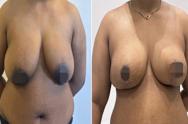 Best Breast Lift surgery in islmabad