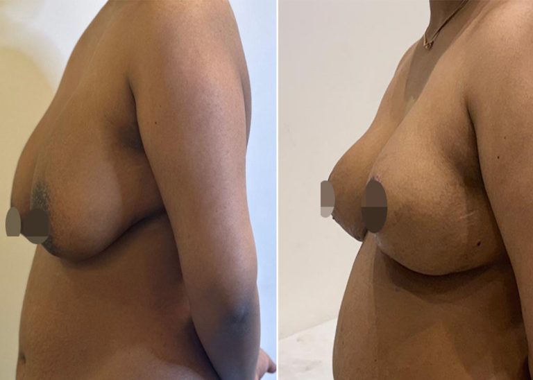 Best Breast Lift surgery in islmabad