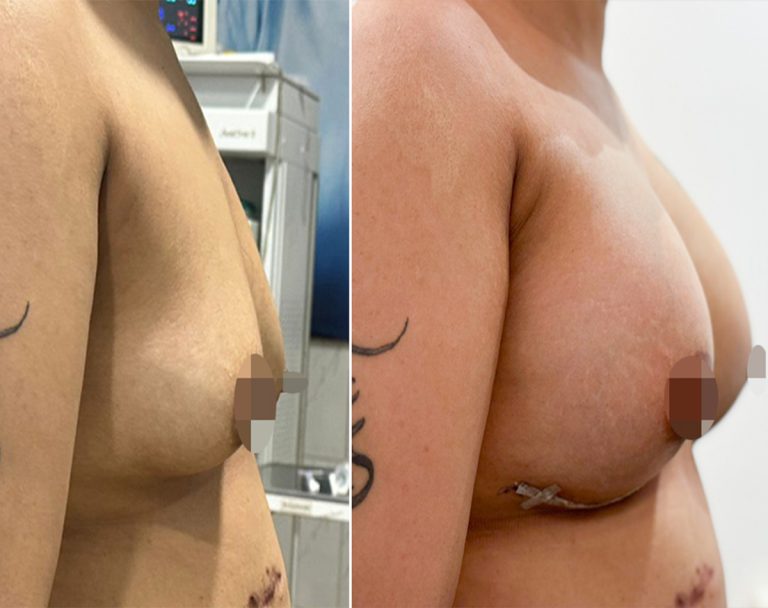 Best Breast Enlargment surgery in islmabad